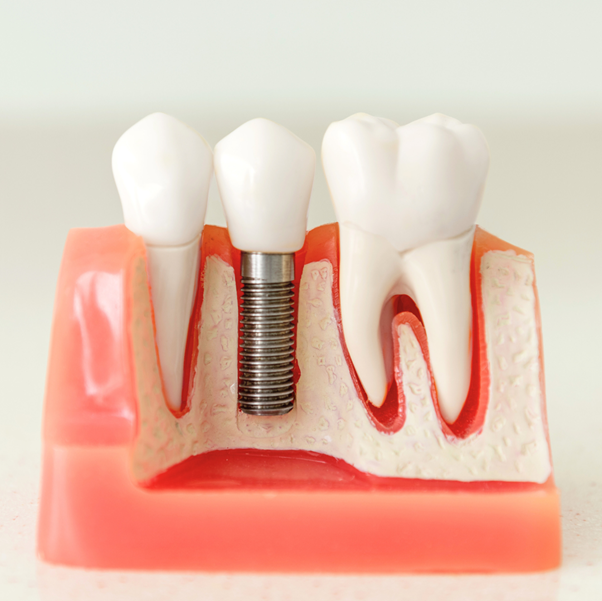 dental implants cost Singapore